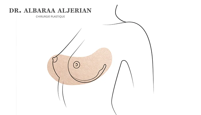 تجميل الثدي في السعودية