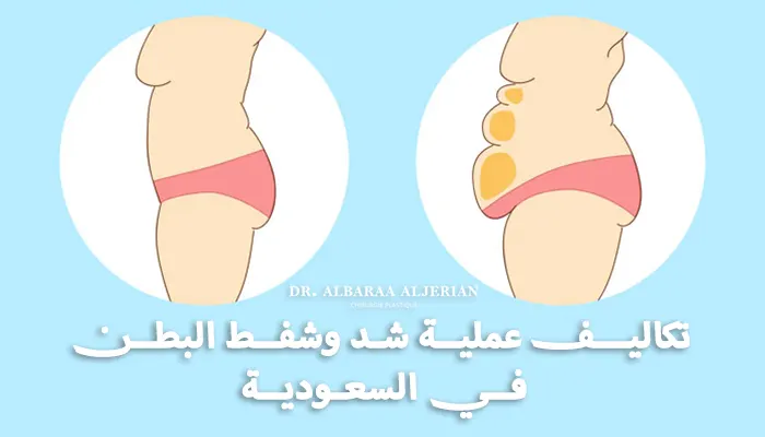 تكاليف عملية شد وشفط البطن في السعودية