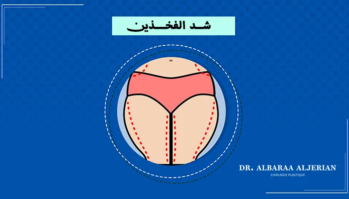 شد الفخذين: الخيارات الجراحية وغير الجراحية