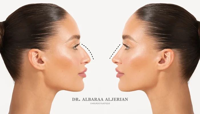 تجميل الأنف غير جراحي (Non-Surgical Rhinoplasty)