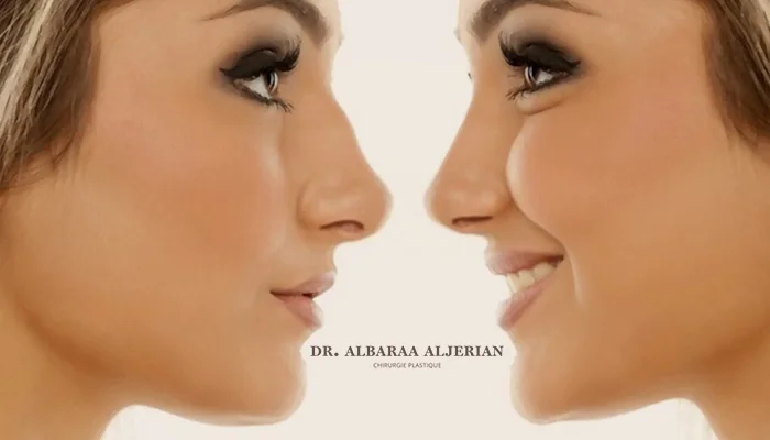 هل يمكن تجميل الأنف بدون جراحة؟