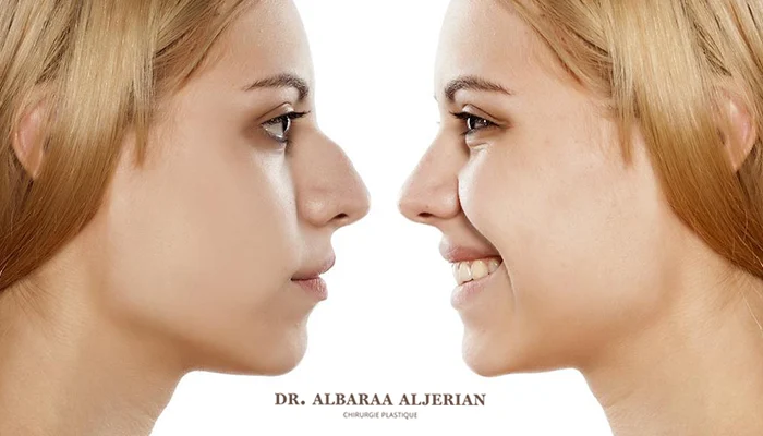 متى تظهر النتيجة النهائية بعد تجميل الأنف؟