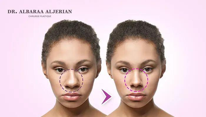 تجميل الأنف العريض بالرياض